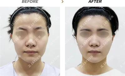 Before & After