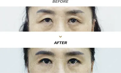 Before & After