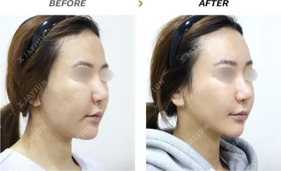 Before & After