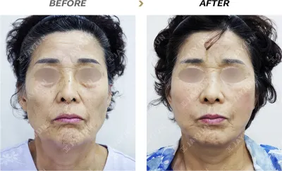 Before & After