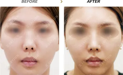 Before & After
