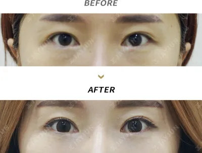 Before & After