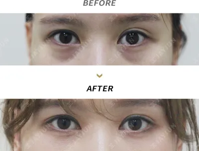 Before & After
