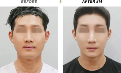 Before & After