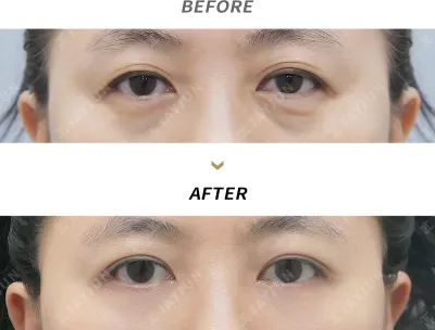 Before & After