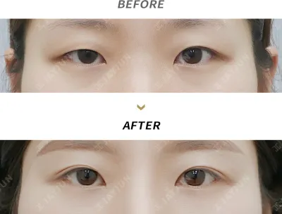 Before & After
