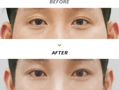 Before & After