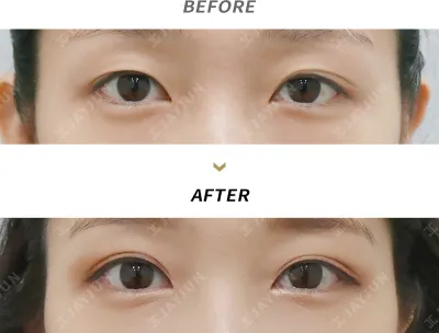 Before & After