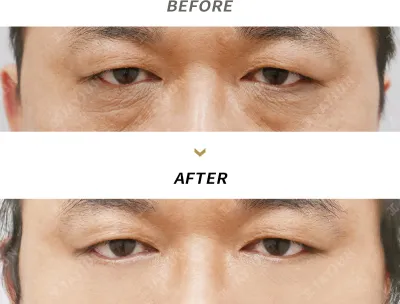 Before & After