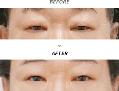 Before & After