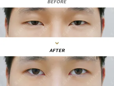 Before & After