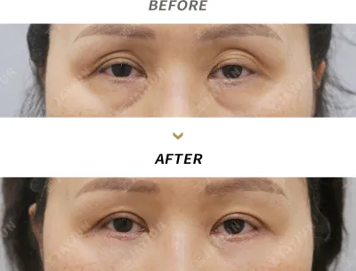 Before & After