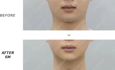Before & After