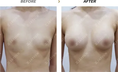Before & After