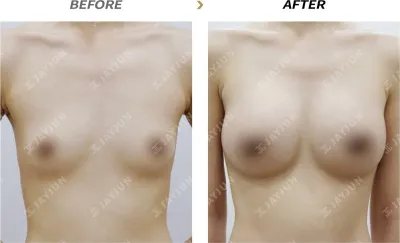 Before & After