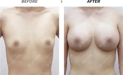 Before & After
