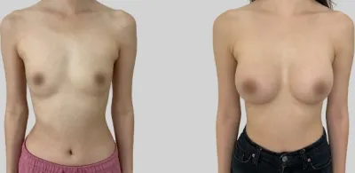 Before & After