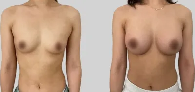 Before & After