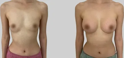 Before & After