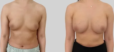 Before & After