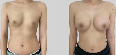Before & After