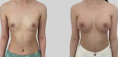 Before & After