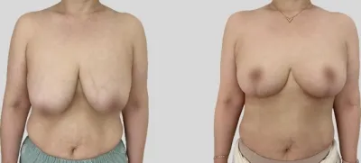 Before & After