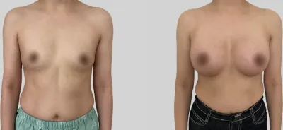 Before & After