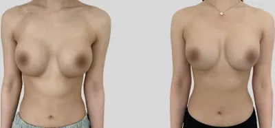 Before & After