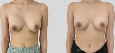 Before & After