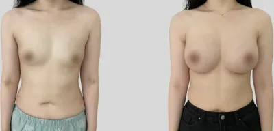 Before & After