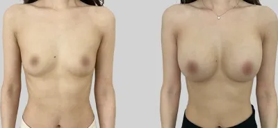 Before & After