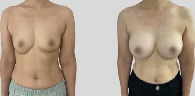 Before & After