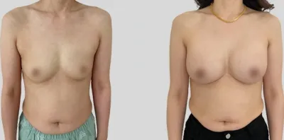 Before & After