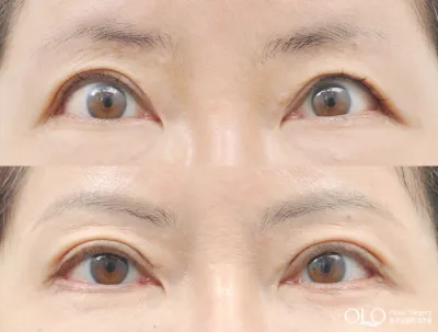 Before & After