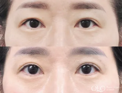 Before & After