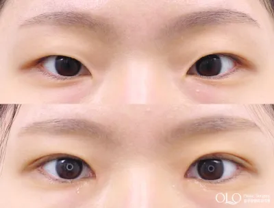Before & After
