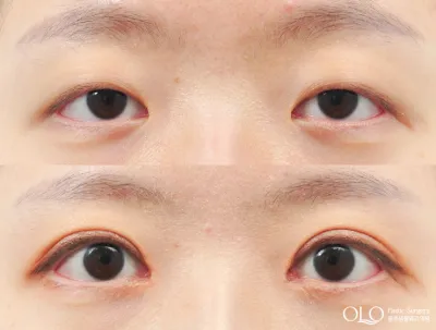 Before & After
