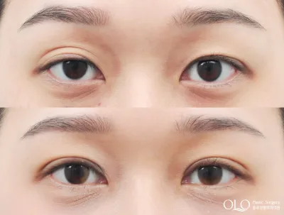 Before & After
