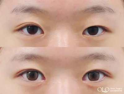 Before & After