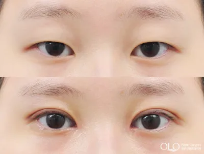 Before & After
