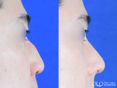 Before & After