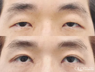 Before & After