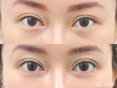Before & After