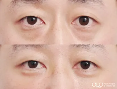 Before & After