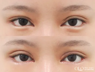 Before & After