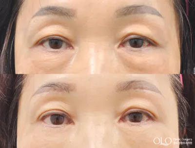 Before & After