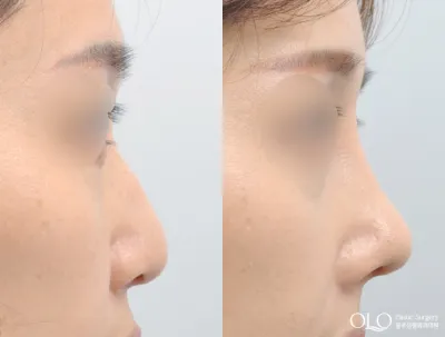 Before & After