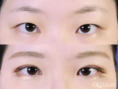 Before & After