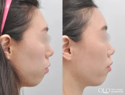 Before & After